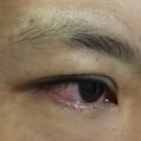 더블류성형외과 네이버블로그