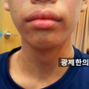 사춘기아토피, 실제 극복 사례로 보는 1가지 특징