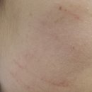 피네의원 | 신사역 피부과 추천 인모드fx 후기 효과 멍 부작용 주기