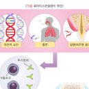 류마티스 초기 관절염 손가락 류마티스 원인 예방법 이미지