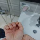 대전화병원 | 아기 밥솥화상 치료후기(실비보험 청구후기)