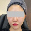 (주)멍이사랑 | 압구정로데오피부과 신상 스킨부터 셀르디엠 비포에프터 다운타임 14일간 매일 전후비교 후기