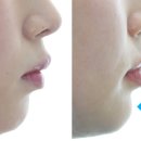 가지런한치과교정과치과의원 | 잠실교정치과 설측교정, 사랑니 공간 활용해 비뚤함과 돌출입 개선한 비발치교정