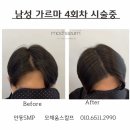 모채움스칼프 | 안동두피문신. SMP 잘하는 곳 ♥︎ 모채움스칼프 ♥︎ SMP 가르마 시술 후기 / 시술 후 관리법