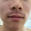 미채움의원 | 남자 수염 레이저제모(클라리티2) 5회차 후기