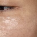 파랑새피부과의원 네이버블로그