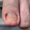 안양무좀발톱 무좀 고민이라면 이 후기 꼭 보세요