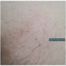 이진탁피부과의원 | 고통스러운 지루성피부염으로 이진탁피부과에 다녀왔어요