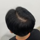 림스칼프 이미지