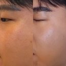 욜로클린 | 명동피부과 엘라비에 리투오손주사·스킨바이브 후기｜스킨보톡스 효과·통증·유지기간까지