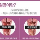 칸디다 질염 재발 원인 및 증상 예방법 이미지