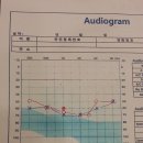 청력 그래프와 보청기선택... 이미지