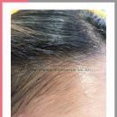 헤어라인왁싱(Hairline Waxing)으로 연예인처럼 이쁜이마 만드세요~ 이미지