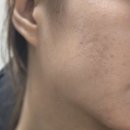 레이저솔루션 | [여드름 붉은자국 레이저] 시너지포커스테라피 내돈내산 찐 후기