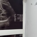 11545-05-07-21 | 마포구산부인과 진오비 선택이유 세 가지, 심상덕원장님 진료후기 진오비무통주사