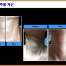 아프로존 루비셀 체험동영상,팔자주름,눈가주름,미간주름,트러플피부,민감성피부,목주름,고양이주름,입가주름 이미지