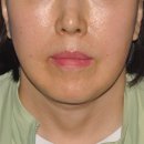 리프트업성형외과의원 | (CASE) 안면거상술 8cases [리프트업성형외과]