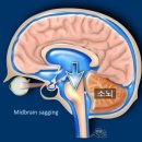 삼계제일약국 | 앉거나 일어서면 머리가 깨질듯한데, 눕자마자 낫는 두통,자발성 두개내 저압증ㅣ전조증상부터 완치...