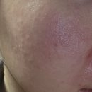 봄봄한의원 | [천안 한우물한의원] 피부 발진, 오돌토돌 열감 3주 만에 잡은 내돈내산 솔직 후기