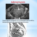 Adenomyosis 이미지