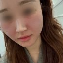 미라셀(주) | 홍대피부과 줄기세포주사 미라셀 후기｜가격·과정·효과·부작용·주의사항