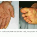 넥사바 부작용-피부 질환-사진과 임상 양상 이미지