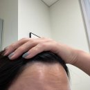 미톡스외과의원 | 내돈내산 주름보톡스 후기 (이마/미간/콧등보톡스) feat.코어톡스, 부작용, 사후관리까지 완벽한 송파...