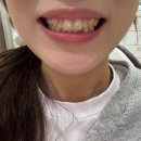 임플라인치과의원 | 강남임플라인치과 치아미백 후기 +치아노트로 관리