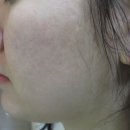 리유한의원 여드름흉터 치료 차오름침 5세트 가격 내돈내산 후기