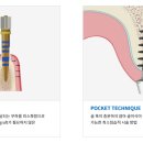 이노바이오써지 이미지