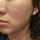 청담동피부과 볼륨차오름 쥬베룩 볼륨 가격 찐 후기