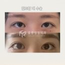고고성형외과의원 | 앞트임 재수술 강남 훌륭성형외과 앞트임 수술 후기 1개월차