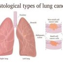 소세포폐암 초기 증상 소세포암 항암제 치료 투병과정 이미지