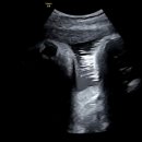 메디티오 | [임신30주]하혈 및 수축 극복 후 임신후기 진입/ 찰랑찰랑 배냇머리/임산부 튼살크림 6종 (극히 개인적...