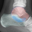 우성 C & P(씨앤피) | 족근결합(Tarsal Coalition)이란? — 원인부터 최신 연구까지 논문 6편으로 정리했습니다