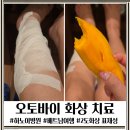 싱싱약국 | 오토바이 배기통 머플러 화상 베트남 하노이 화상치료병원 후기