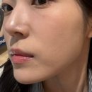 (주)우리메디칼 | 강남역 피부과 꺼진 앞볼 쥬베룩 볼륨 솔직 후기