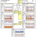 Embolic infarction in hypoplastic A1 &amp; ipsilateral fetal PCA 이미지