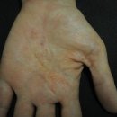 날씬엄마튼튼아이한의원 | 내 아이 피부, 왜 이런지 알고싶어요,아토피 화폐상습진치료