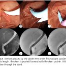 Stents 이미지