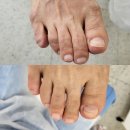 연제구-180 | 부산레푸스 발 건강 고민 해결, 레푸스 연산시청점 부산내성발톱 관리 후기