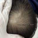 정수리 | 김포두피문신 정수리탈모 후기
