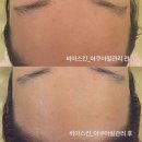 비아스킨