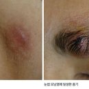 종기[ furuncle음성듣기 이미지