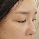 엑스텀 | 역삼동피부과 비올 실펌엑스 받고 피부결 윤기 살아난 후기