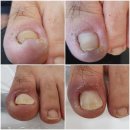 에이티엔 | 목포 파고드는 내성발톱, 발각질, 무좀발톱 관리 네일샵 페디네일