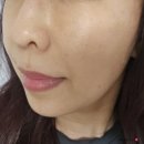 강남역피부과 고우리 스킨부스터 솔직 후기