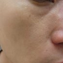 호픈커피비엔 | 남양주피부과에서 콧등색소침착레이져치료후기 , 남양주 별내 커피맛집 호픈커피비엔(내돈내산)