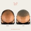 TMW 탈모왕수원 네이버블로그