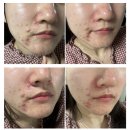 뷰티솔루션스 | [내돈내산] 뷰티세움 LED 피부미용기기 고민 끝에 사다…! 3달 사용 후기★☆